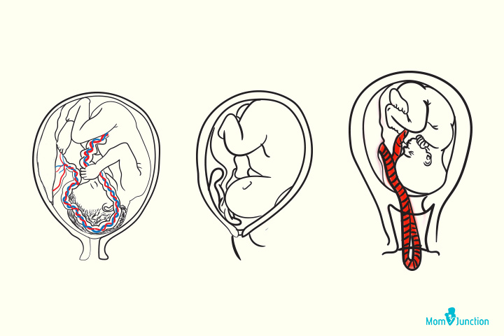 Cord Prolapse Causes Diagnosis And Management