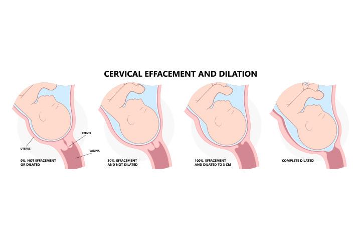 Cervix Dilation Chart: Signs, Stages And Procedure To Check, 54% OFF