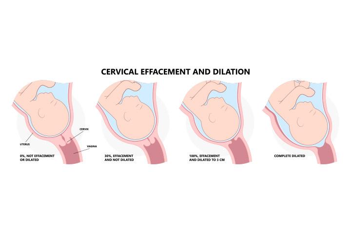Cervix Dilation Chart Signs Stages And Procedure To Check 54 OFF