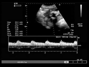 Fetal Heartbeat Week-By-Week Chart And Methods Used To Monitor It