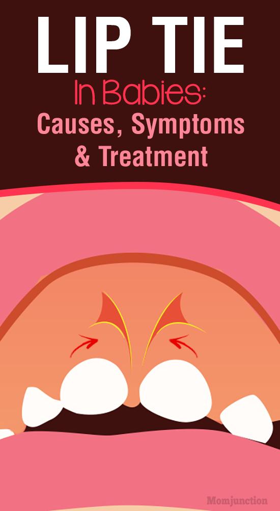 lip-tie-in-babies-causes-symptoms-treatment