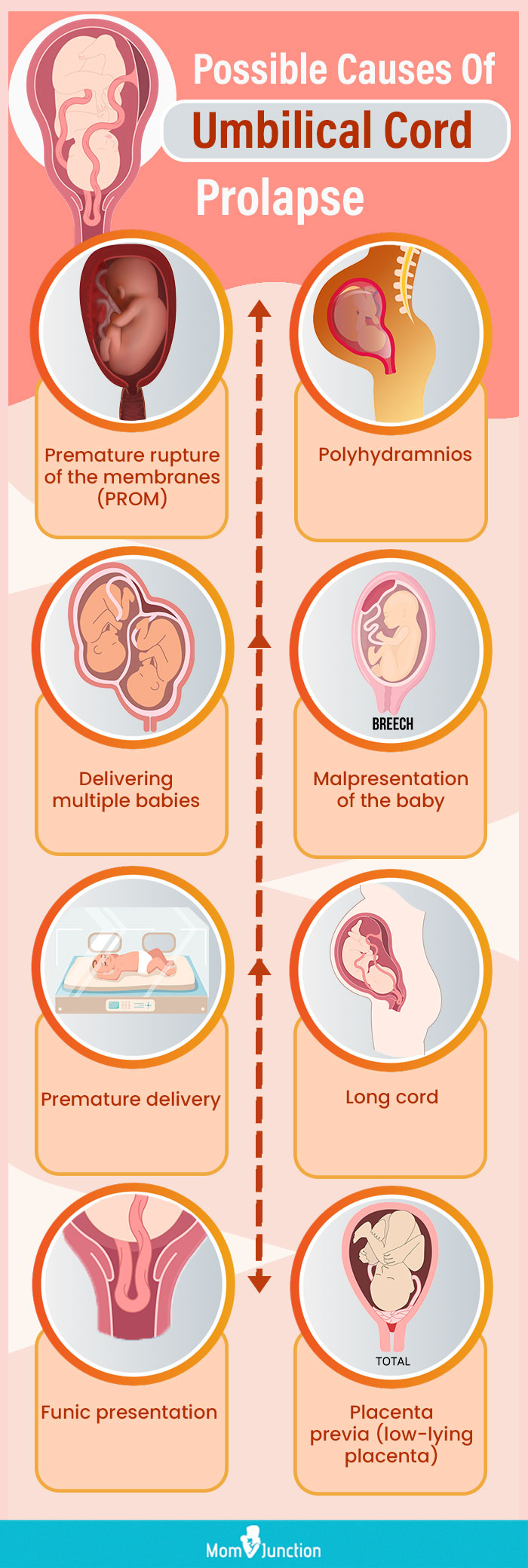 possible causes of umbilical cord prolapse (infographic)