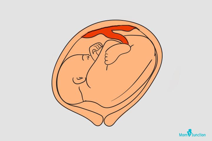 Transverse Lie Causes And Ways To Turn The Baby