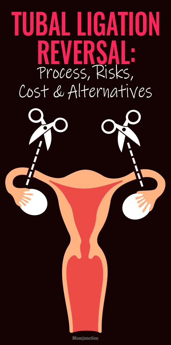 tubal-ligation-reversal-process-risks-cost-and-alternatives