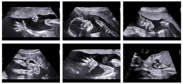 What Is Anomaly Scan During Pregnancy And Why Is It Done ?