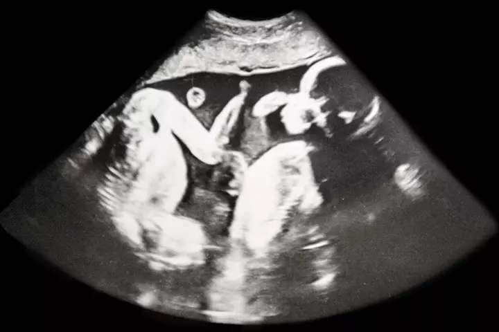 babies fighting inside the womb