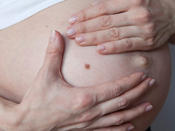 Does Your Pregnancy Make Melanoma More Dangerous?