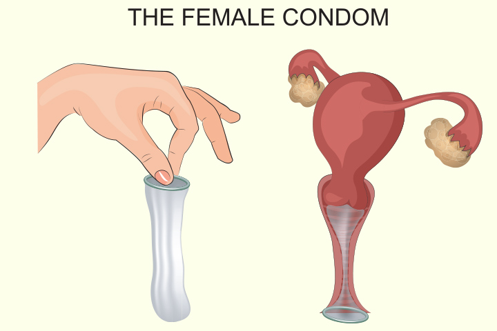  Female condom