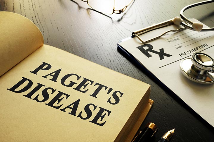 Pagets Disease