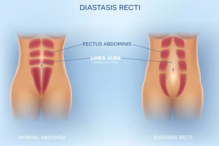 Stretching Of The Skin And Muscles