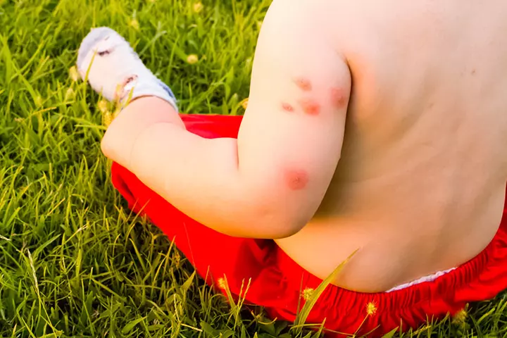 Eczema 
