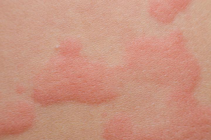 Papular Urticaria, skin allergy in babies