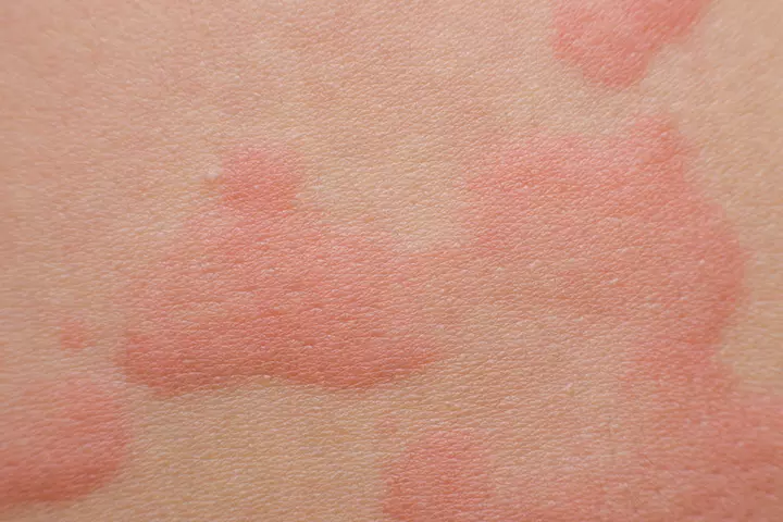 Papular Urticaria, skin allergy in babies