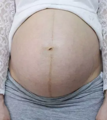 गर्भावस्था के दौरान पेट पर काली रेखा (लिनिया नाइग्रा) | Pregnancy Me Pet Par Kali Line