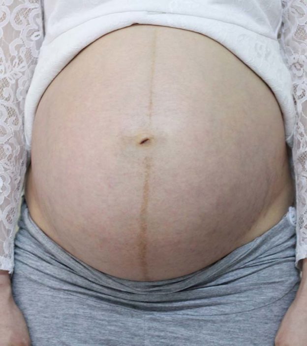 गर्भावस्था के दौरान पेट पर काली रेखा (लिनिया नाइग्रा) | Pregnancy Me Pet Par Kali Line