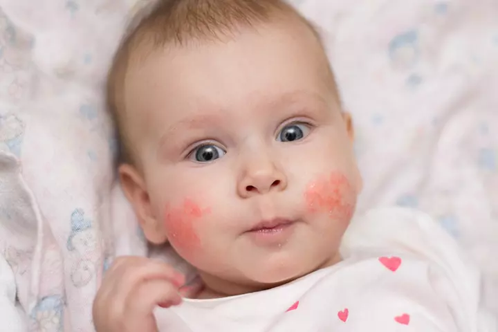 Signs And Symptoms Of Allergies