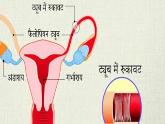 फैलोपियन ट्यूब रुकावट: लक्षण, उपचार व लागत | Fallopian Tube Blockage Treatment In Hindi