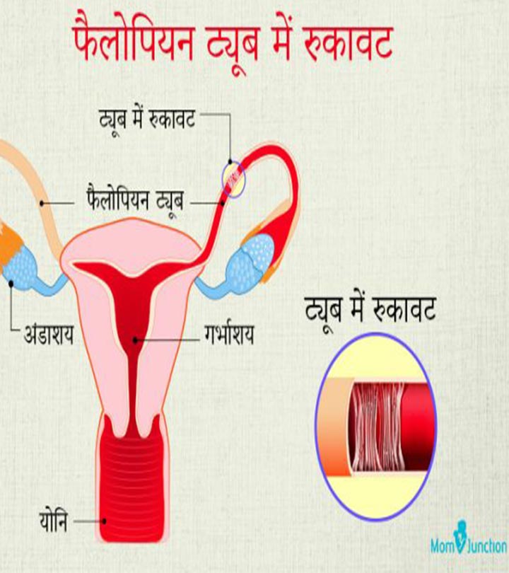 फैलोपियन ट्यूब रुकावट: लक्षण, उपचार व लागत | Fallopian Tube Blockage Treatment In Hindi