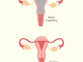 मोलर प्रेगनेंसी (दाढ़ गर्भावस्था) : कारण, लक्षण व उपचार | Molar Pregnancy Kya Hai