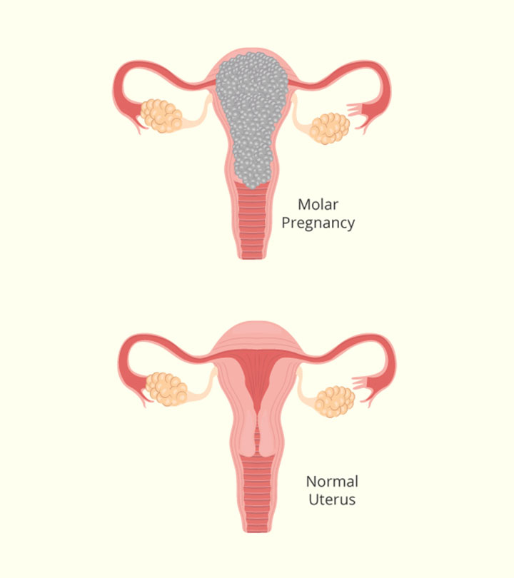 मोलर प्रेगनेंसी (दाढ़ गर्भावस्था) : कारण, लक्षण व उपचार | Molar Pregnancy Kya Hai