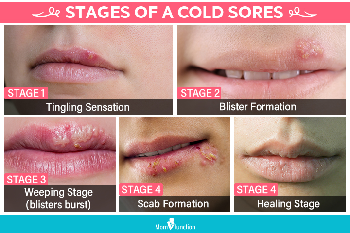 Stages of cold sores during pregnancy