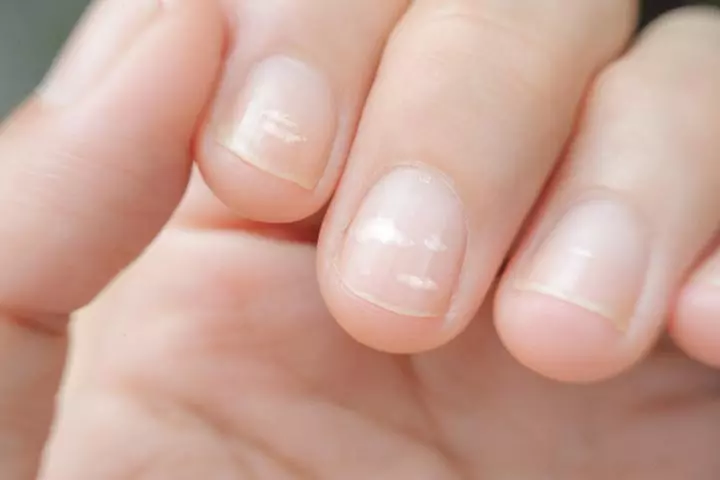 White Spots On Nails