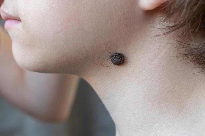 Certain moles are also considered as birthmarks if you are born with them