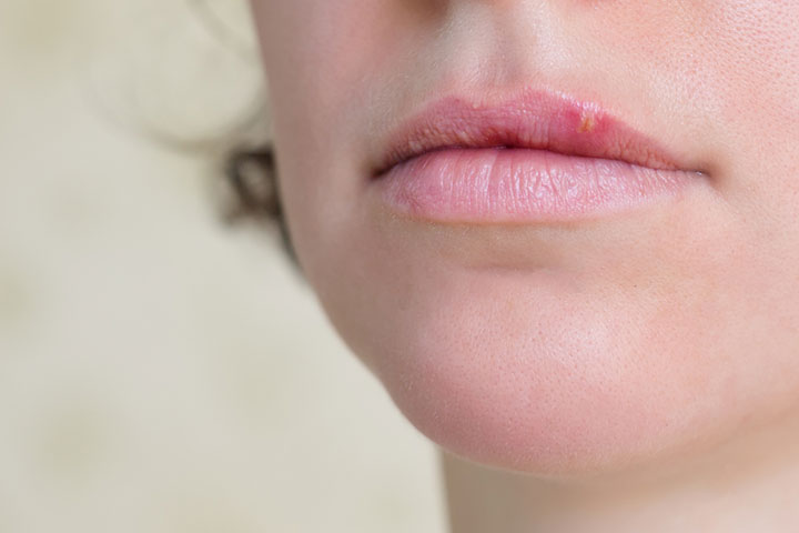 Cold Sores How To Identify It