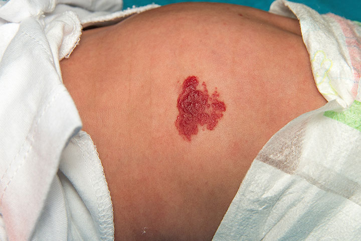 There are various types of birthmarks