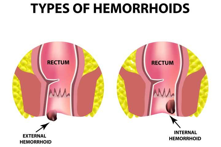 Hemorrhoids relief after pregnancy