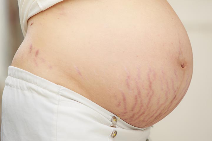 Are Pregnancy Stretch Marks Worrying You Here’s What You Can Do
