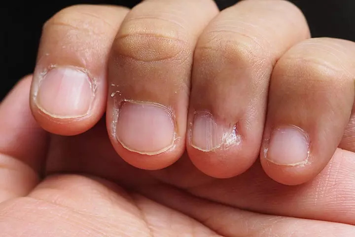 Cutting Nails Too Short