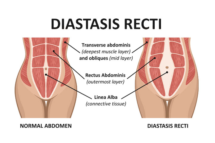 The Best Movements That Are Safe In Pregnancy (2021) Diastasis Recti Correction
