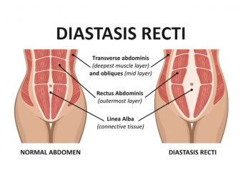 Diastasis Recti: Causes, Symptoms, Diagnosis And Treatment