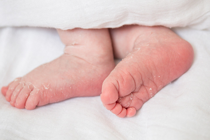 Causes For Newborn Skin Peeling