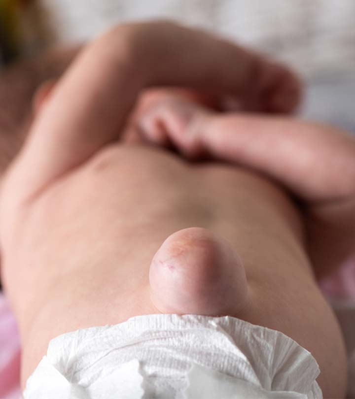 शिशु और बच्चों में हर्निया (Hernia) के कारण, लक्षण व इलाज