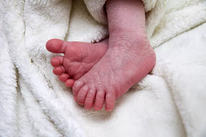 How To Deal With Newborn Skin Peeling