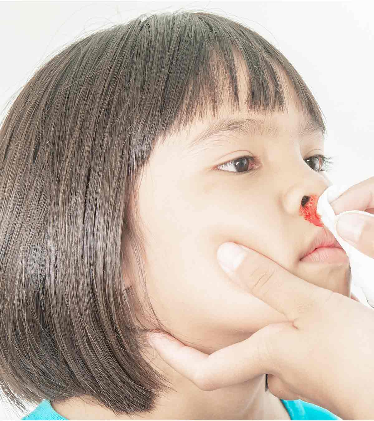 बच्चों की नाक से खून (नकसीर) आना | Baccho Ki Naak Se Khoon Kyu Nikalta Hai