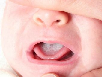 बच्चों के मुंह में छाले (Oral Thrush) का इलाज व घरेलू उपाय | Baccho Ke Muh Mein Chhale