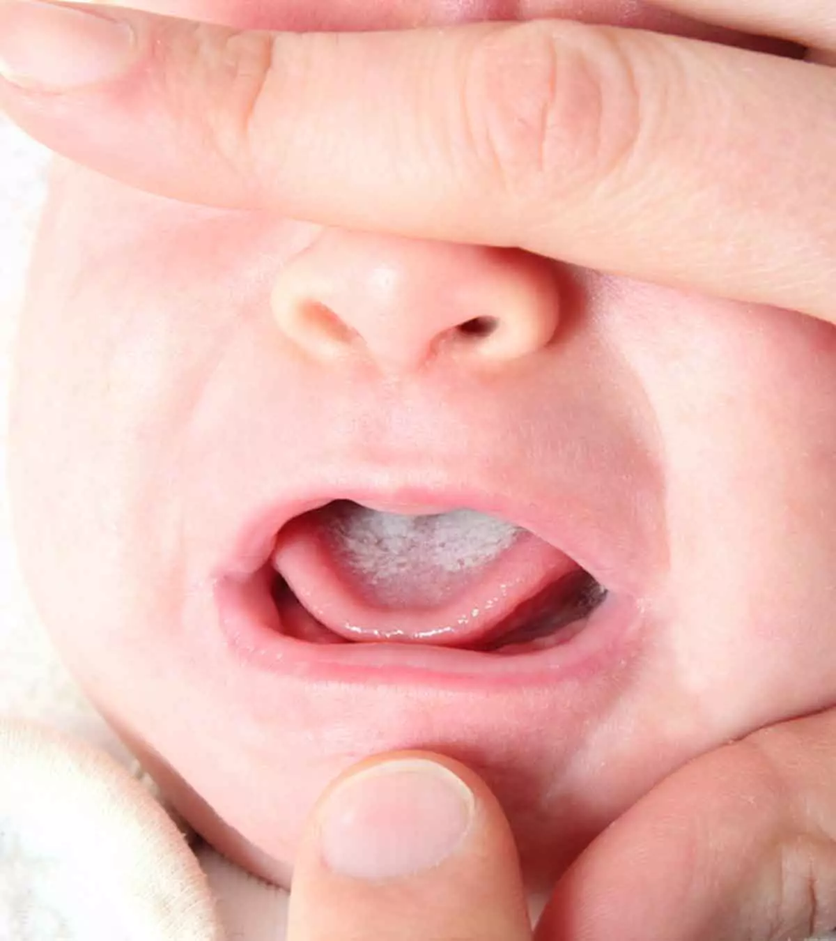 बच्चों के मुंह में छाले (Oral Thrush) का इलाज व घरेलू उपाय | Baccho Ke Muh Mein Chhale
