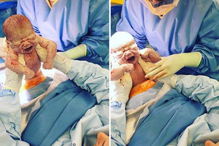 Mom Delivers Her Own C-Section Baby