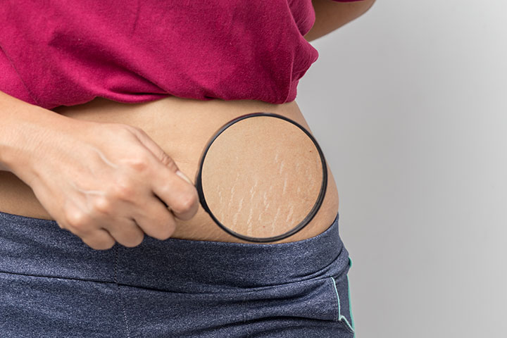 Stretch marks are fine lines that appear on the body during a period of rapid growth