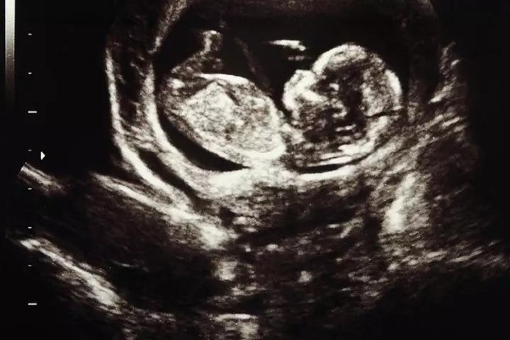Fetal development week 13