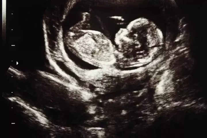 Fetal development week 13