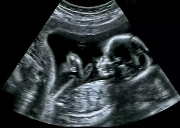 Fetal development week 14