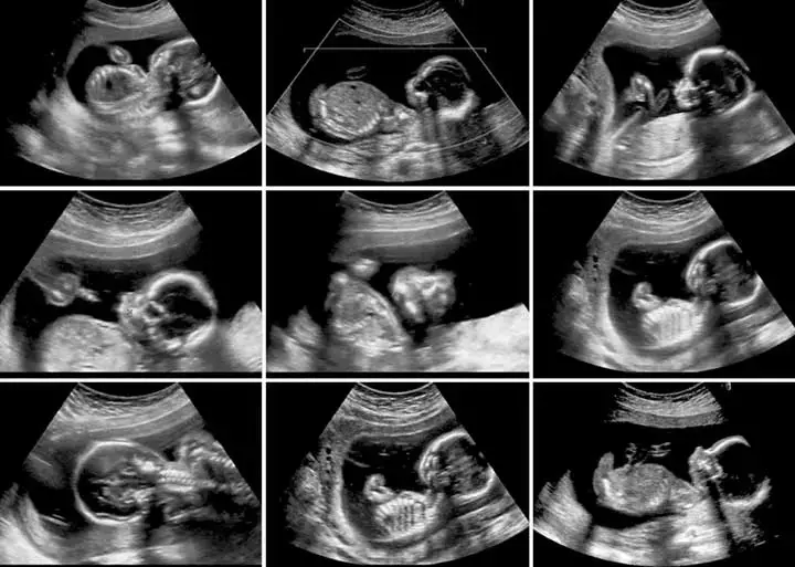 Fetal development week 20