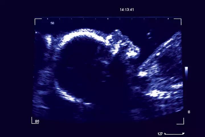 Fetal development week 26
