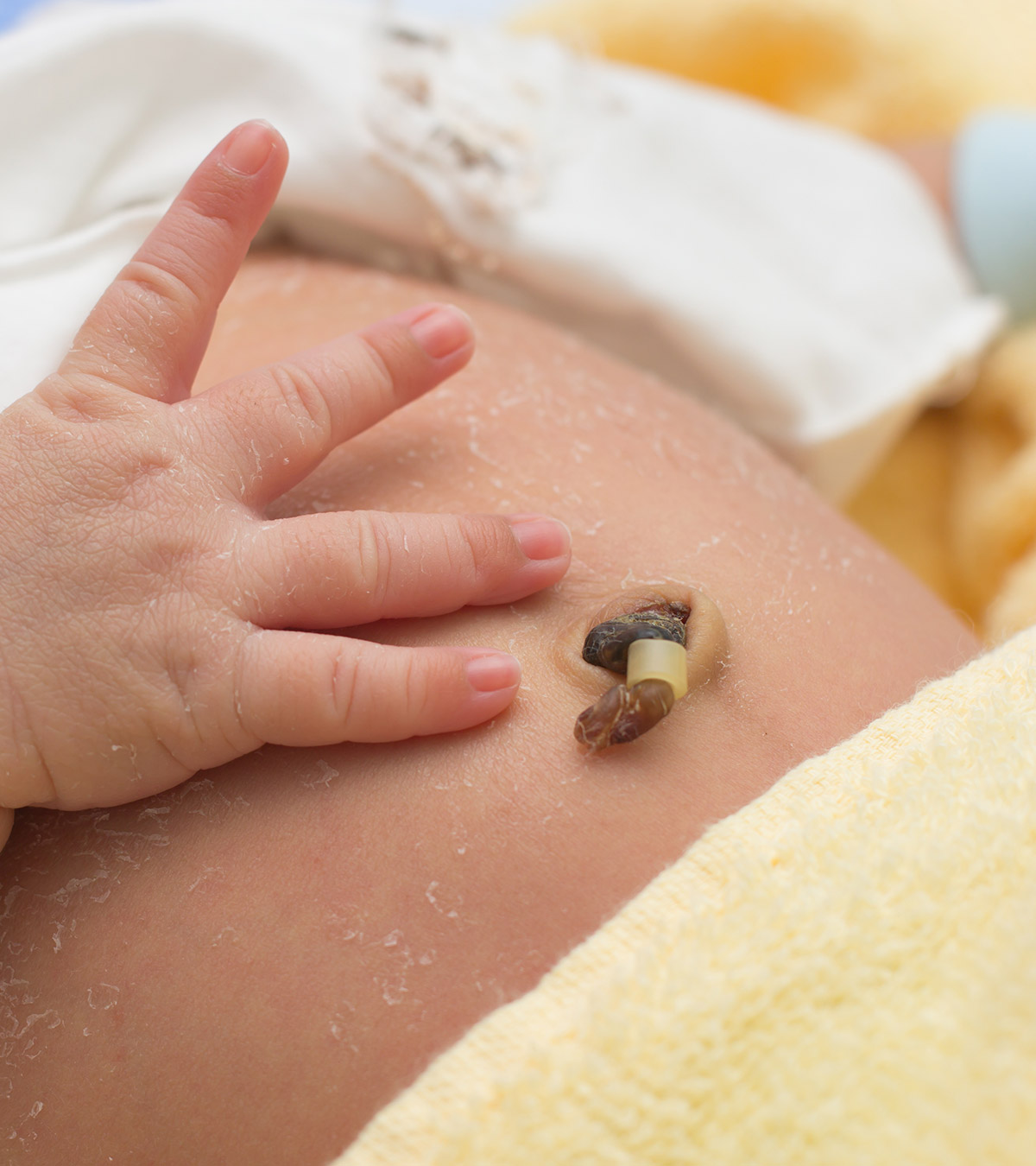 शिशु के गर्भनाल (ठूंठ) की देखभाल | Newborn Baby Ki Naal Care
