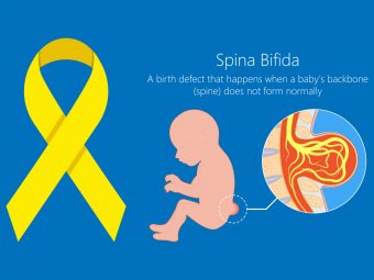 स्पाइना बिफिडा क्या है? कारण, लक्षण व इलाज | Spina Bifida In Hindi