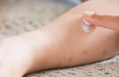 Calamine Lotion for Babies: Uses, Safety And Side Effects